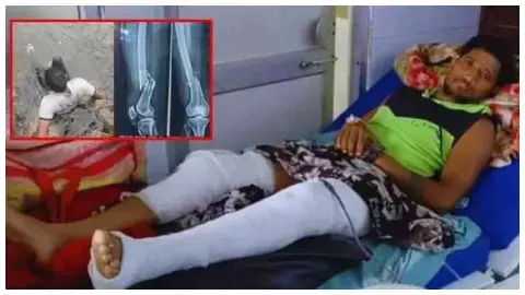 Jhansi News: रील के लिए 30 फीट से बांध में कूदा युवक, दोनों पैर टूटे