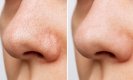 Blackheads Remedies: ब्लैकहेड्स की समस्या से परेशान हैं तो आजमाएं ये घरेलू उपाय