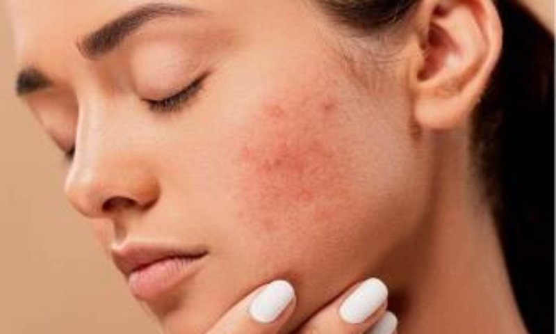 How to Treat Redness on Face: फेशियल के बाद आपके चेहरे पर भी आ जाती है रेडनेस? जानिए ये घरेलू उपचार