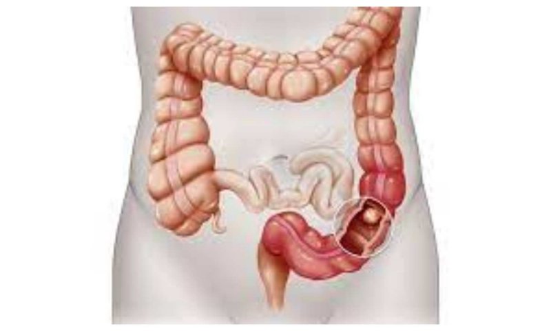 Colorectal Cancer: युवा वयस्कों में तेज़ी से बढ़ रहा है कोलन कैंसर, जानिये इसके चेतावनी संकेत और जोखिम कारक