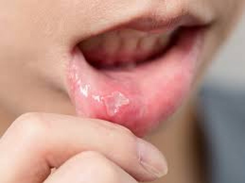 Oral Cancer Ke Lakshan: मुंह के कैंसर के पहले लक्षण जानने के बाद क्या होना चाहिए आपका अगला कदम, जानिये विशेषज्ञों की राय