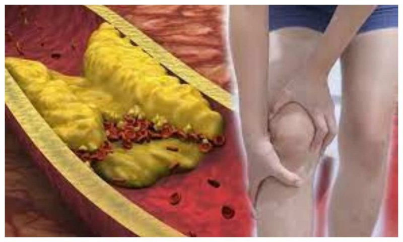 High Cholesterol Symptoms: अगर टांगों में दर्द को चंद मिनटों में ही मिल जाता है आराम , तो हो सकता है हाई कोलेस्ट्रॉल