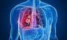 Lung cancer: ये असामान्य लक्षण जो फेफड़ों में कैंसर की वृद्धि के हो सकते हैं कारण, आप भी जानिये