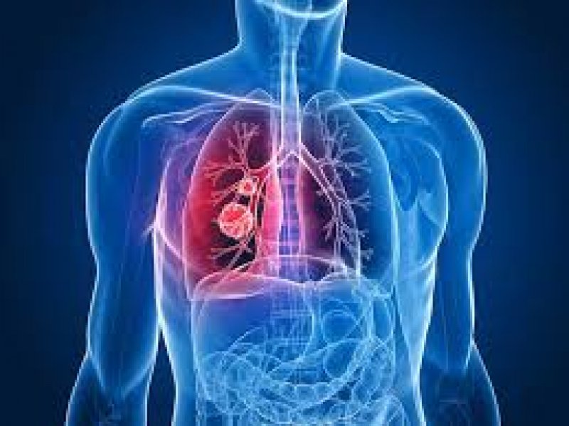 Lung cancer: ये असामान्य लक्षण जो फेफड़ों में कैंसर की वृद्धि के हो सकते हैं कारण, आप भी जानिये