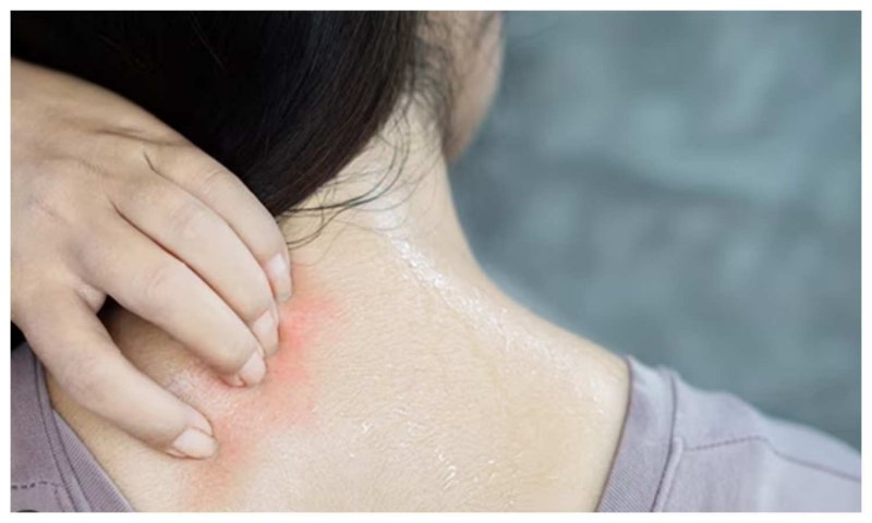 Ayurvedic Remedies For Heat Rashes: आयुर्वेद में छिपा है हीट रैश का इलाज, आप भी देखें