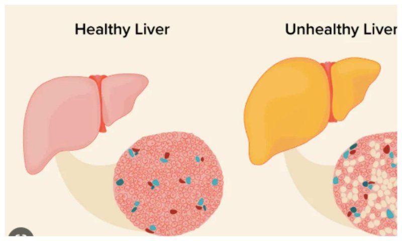 Non Alcoholic Fatty Liver: नॉन अल्कोहॉलिक फैटी लिवर में डाइट का रखें विशेष ख्याल, जानिये इसके लक्षण और उपचार
