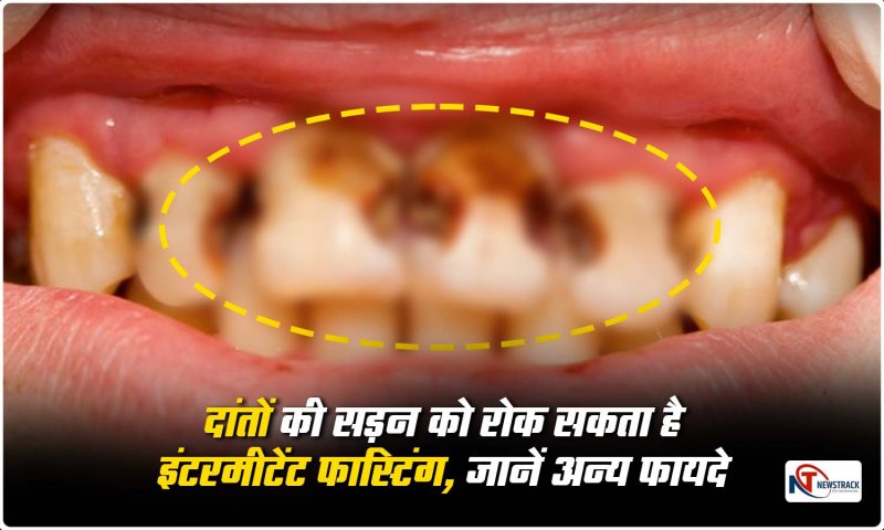 Intermittent Fasting: दांतों की सड़न को रोक सकता है इंटरमीटेंट फास्टिंग, जानें अन्य फायदे