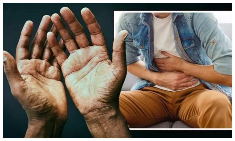 Liver Cirrhosis Symptoms: कहीं आपके हाथों में भी तो नहीं हैं ये लक्षण , तो हो सकता है लिवर सिरोसिस