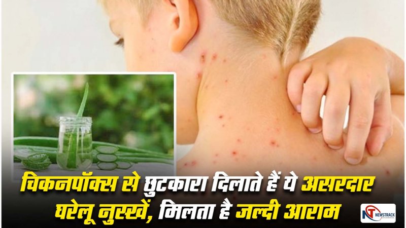 chicken pox ka gharelu upchar in hindi home remedies for chickenpox how