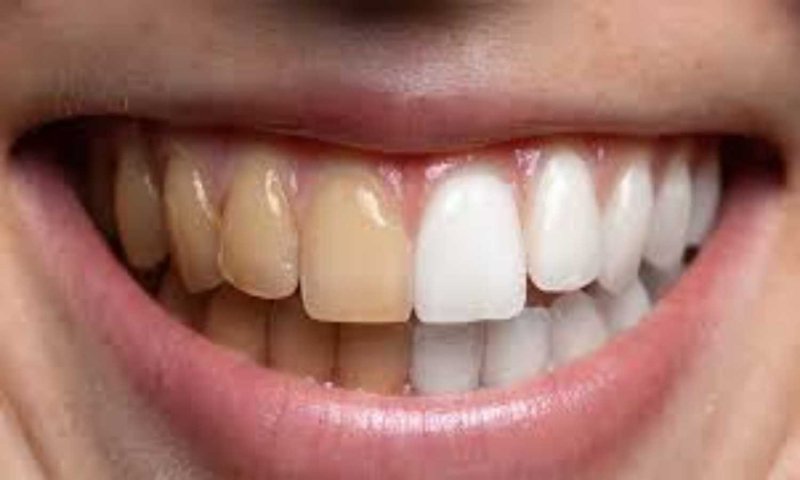 Teeth Whitening Tips: दांतों के पीलेपन को दूर भगाएंगे ये आसान घरेलू नुस्खों, दांत बनेंगे सफ़ेद और चमकदार