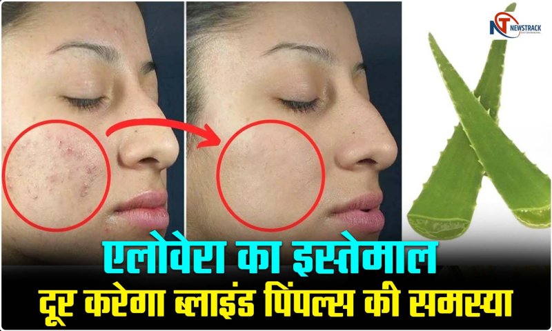 Blind Pimple: एलोवेरा का इस्तेमाल दूर करेगा ब्लाइंड पिंपल्स की समस्या , जानिए लक्षण , कारण और रोकथाम के उपाय