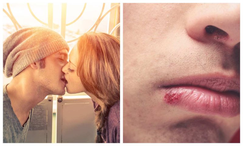 Kissing Disease: कब और कैसे होता है किसिंग डिजीज, जानिये इसे रोकने के उपाय