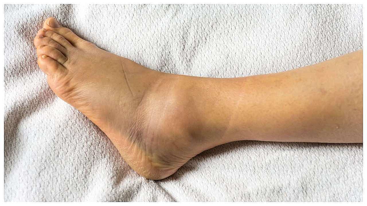 pair-ki-moch-ka-gharelu-upchar-in-hindi-home-remedies-of-sprained-ankle