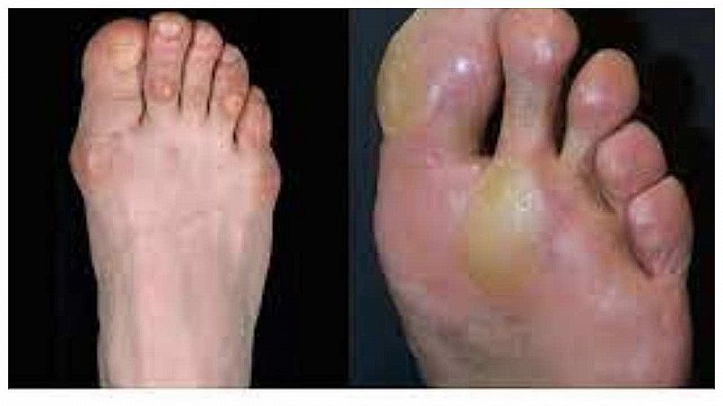 Corns And Calluses: कॉर्न्स और कॉलस की समस्या से हैं परेशान तो जानिये इसके प्रभावशाली घरेलू उपचार