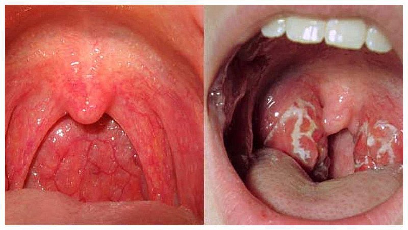 Strep Throat Vs Sore Throat: स्ट्रेप थ्रोट और गले में खराश में क्या होता है अंतर, जानिये कारण और इसका उपचार