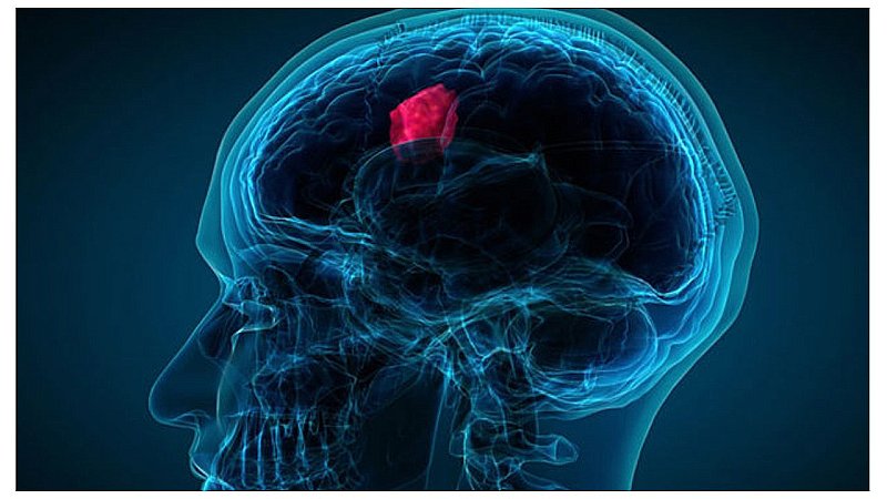 Brain Tumour: सिरदर्द भी हो सकता है ब्रेन ट्यूमर का संकेत, इन लक्षणों को ना करें अनदेखा
