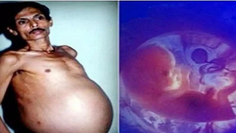 Nagpur Pregnant Man: 36 साल तक प्रेग्नेंट रहा ये शख्स, फिर पैदा हुए जुड़वां बच्चे, जानें हैरान कर देने वाला ये मामला