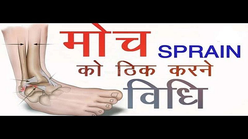 Moch ka Gharelu Upay: जानिए आखिर मोच आने पर क्या लगाकर ठीक हो जायेंगे आप , नहीं खानी पड़ेगी डॉक्टर की कड़वी दवाई