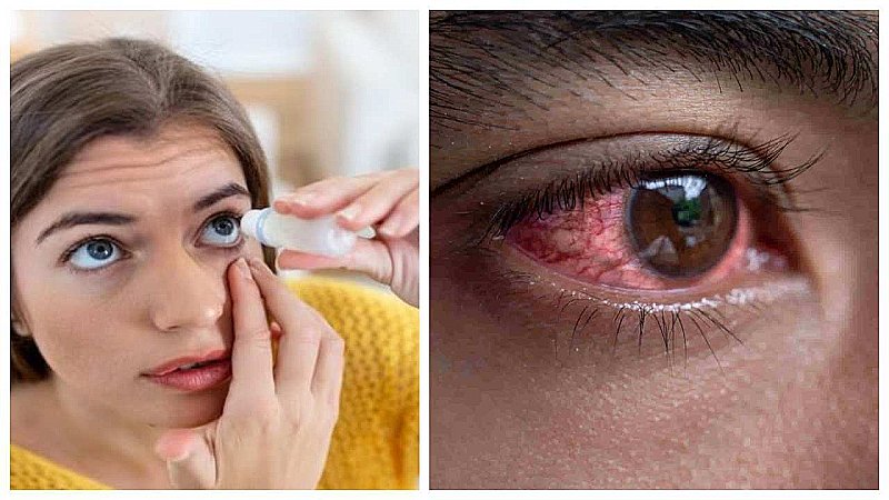 Eye Flu Symptoms and Cure: बरसात के मौसम में बढ़ जाता है आई फ्लू का खतरा, डॉक्टर से जानें लक्षण और इलाज
