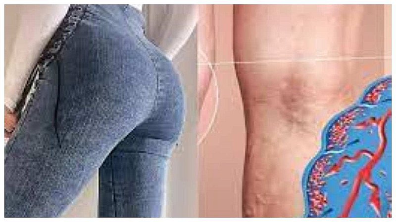 Tight Jeans Side Effects: टाइट जींस पहनने वाली लड़कियाँ संभल जाएं, इन बीमारियों का बढ़ता है खतरा