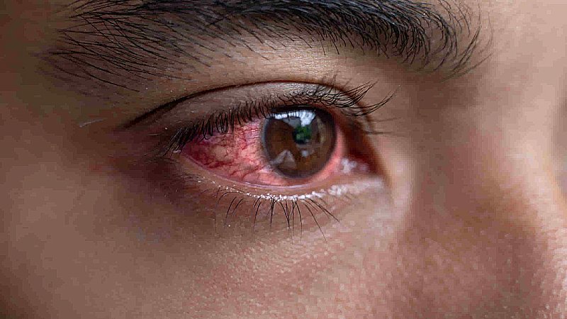 Eye Flu: धबराएं नहीं! आपके रसोईघर में हैं आई फ्लू का इलाज, जानें क्या है?