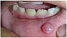 Home Remedies to Treat Mucocele: ओरल सिस्ट की समस्या बन सकता है कैंसर का कारण, जानिये इसे दूर करने के प्रभावी घरेलू उपच