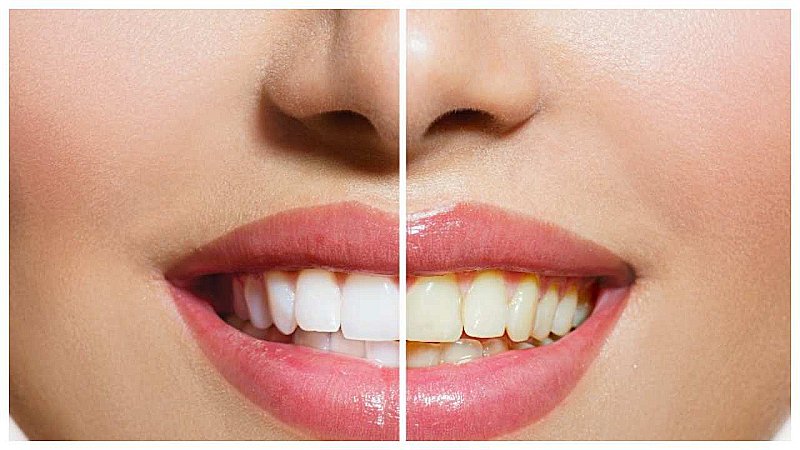 Yellow Teeth Home Remedies: क्या आपके दांत भी हो रहे हैं पीले, जानें इसको सफ़ेद करने के घरेलू उपचार