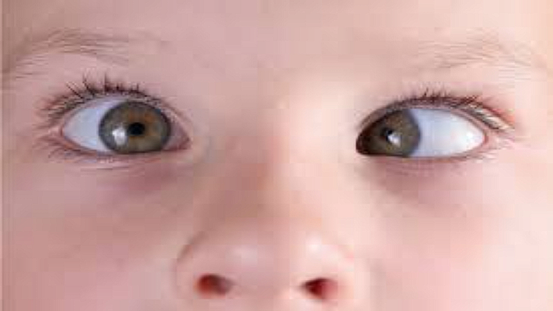 Squint Eye Treatment: बच्चे को है तिरछा देखने की आदत, न करे इग्नोर, जानें इस बीमारी के बारे में और ऐसे करें बचाव