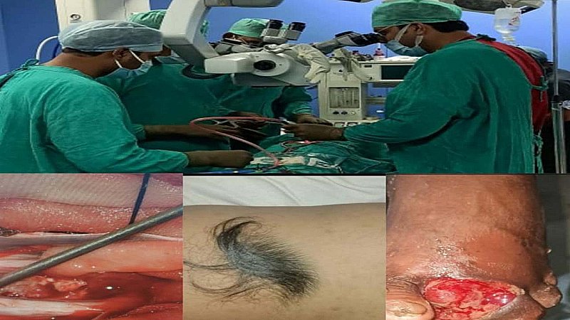 Agra News: 9 साल के राज के चेहरे पर आई मुस्कान, एसएन मेडिकल कॉलेज के डॉक्टरों ने की दुर्लभ सर्जरी